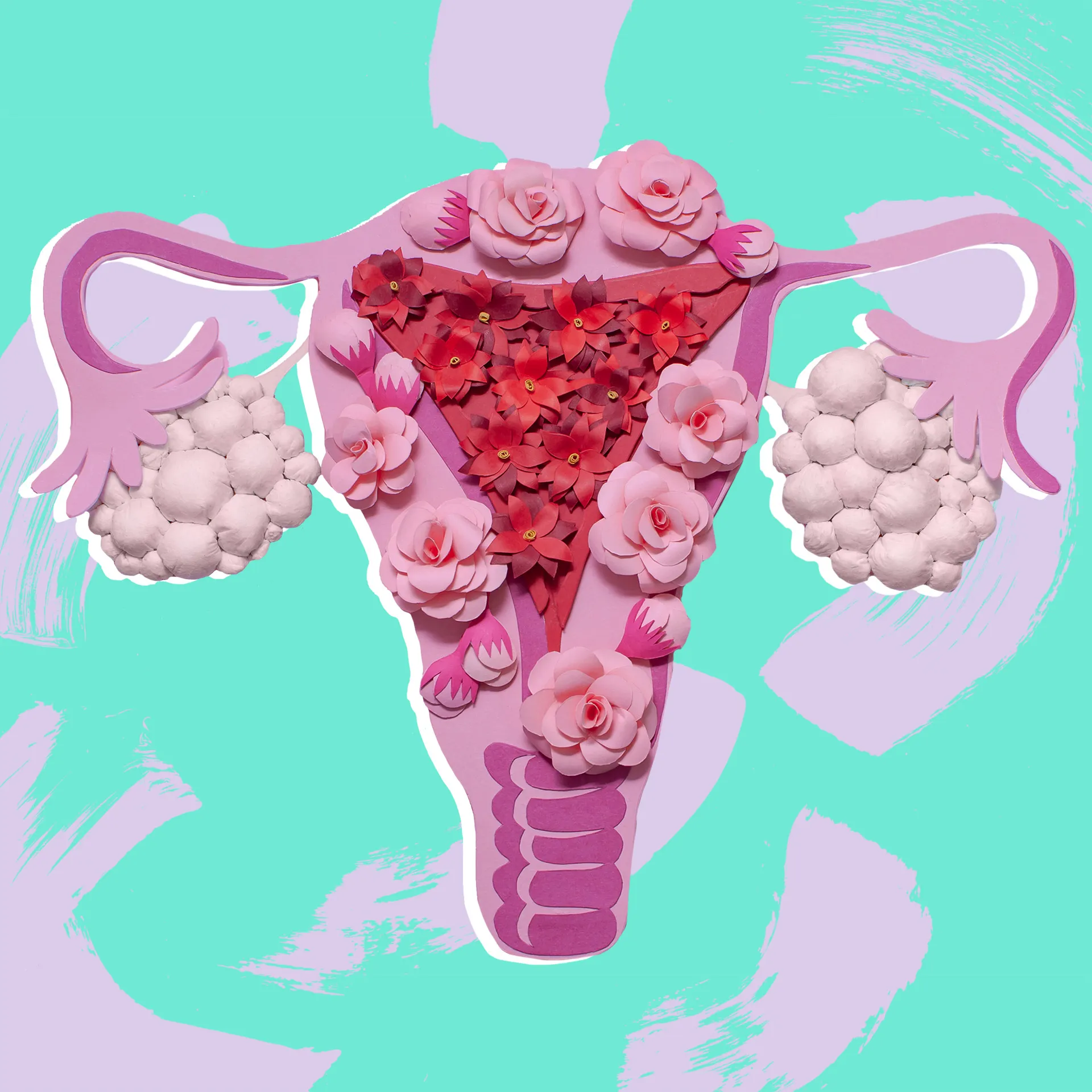 Polikistik Over Sendromu